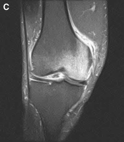 3T MRI of a knee showing a bone marrow lesion and stress beneath the cartilage