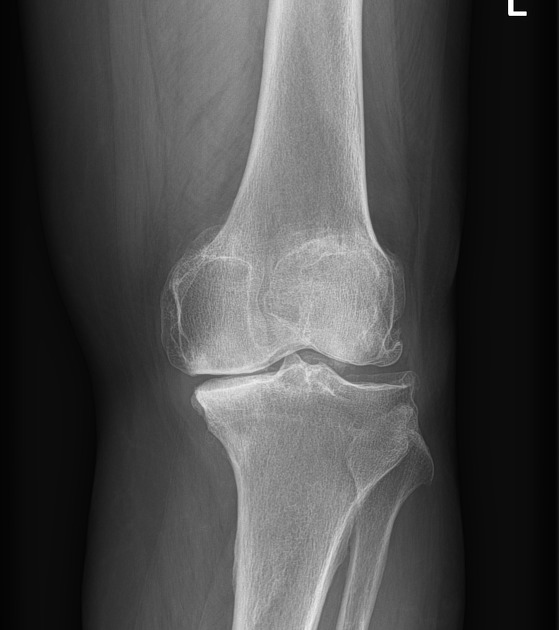 Weight-bearing X-ray of a knee showing joint space and alignment