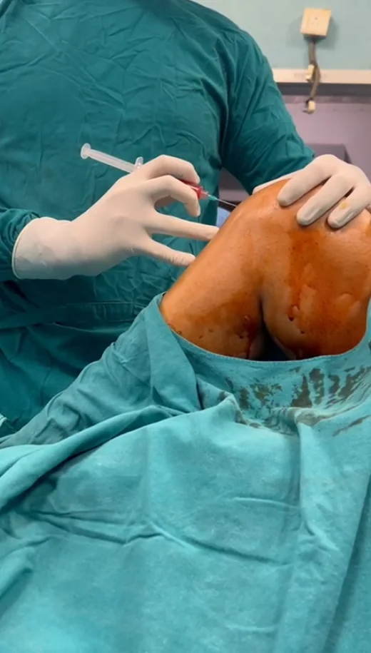 Preparing the subchondral injection