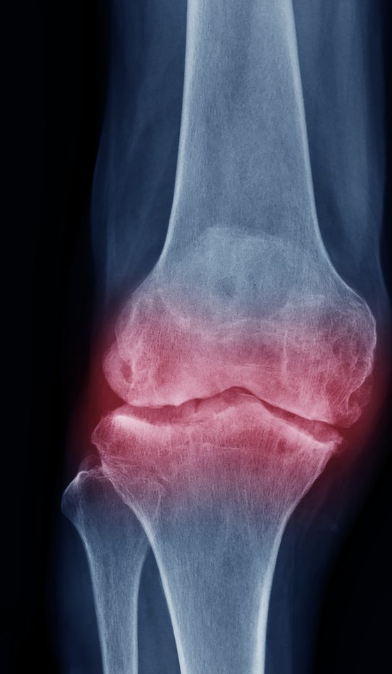 Bone Marrow Edema / Bone Marrow Lesions
